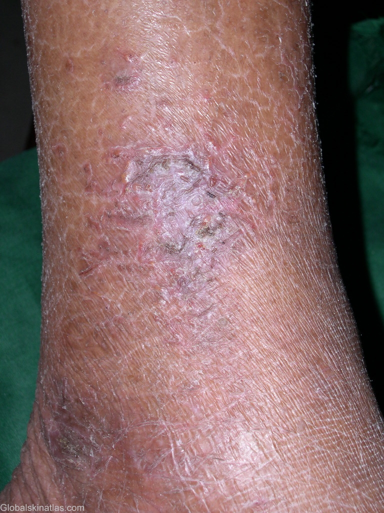 Affections de la peau de la partie inférieure de la jambe · Info santé