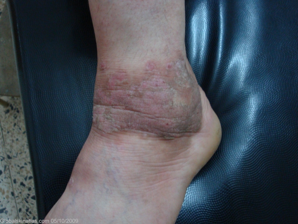 Affections de la peau de la partie inférieure de la jambe · Info santé